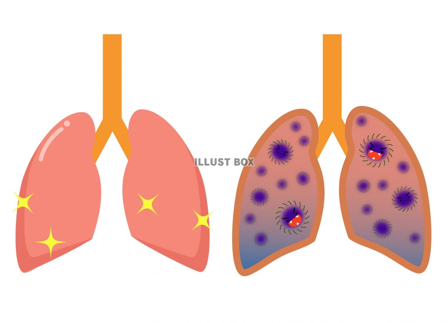 無料イラスト 健康な肺と病気の肺