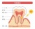 歯のイラスト★知覚過敏★断面図