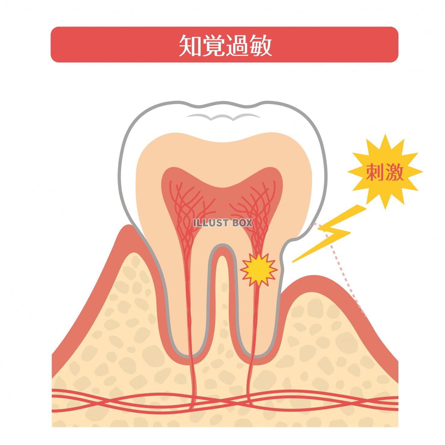 歯のイラスト★知覚過敏★断面図